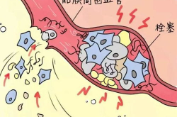 羊水栓塞的原因,多因素交织下的产科危机